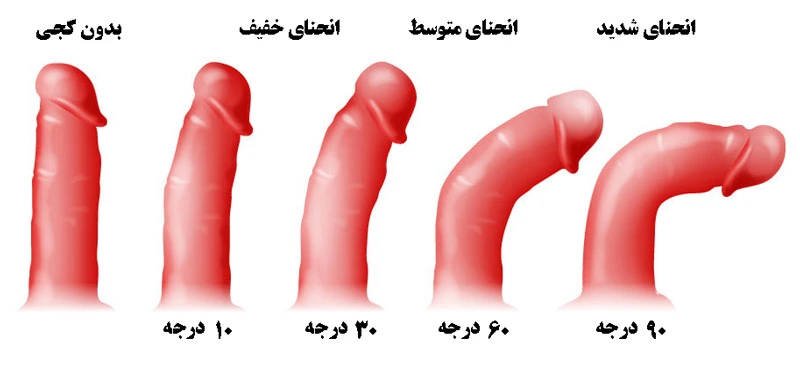 جزاحی انحنای آلت